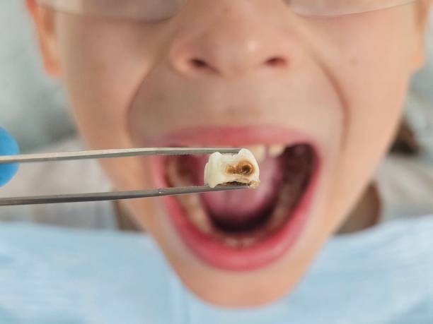 Best Walk-In Emergency Dental Services in Point, TX